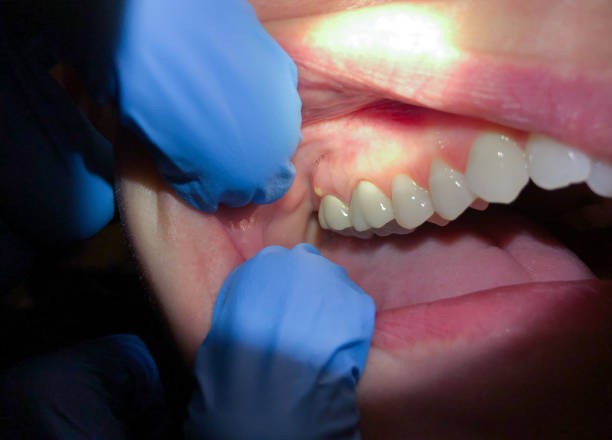 Best Emergency Care for Gum Disease in Warroad, MN
